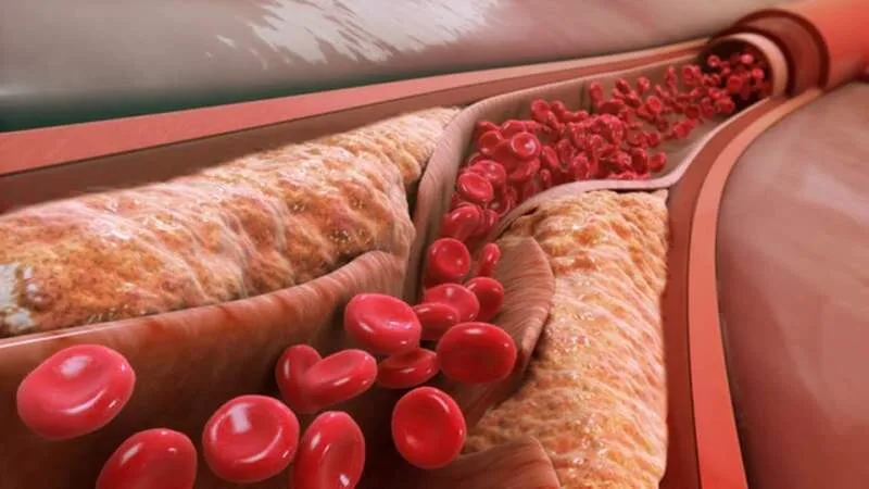 Người có rối loạn lipid máu, bệnh tim mạch, tiểu đường hoặc đang theo chế độ dinh dưỡng điều trị nên thận trọng về khẩu phần