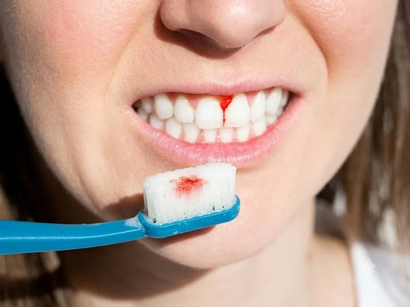 Chảy máu chân răng khi đánh răng có thể do viêm nướu hoặc chải quá mạnh.